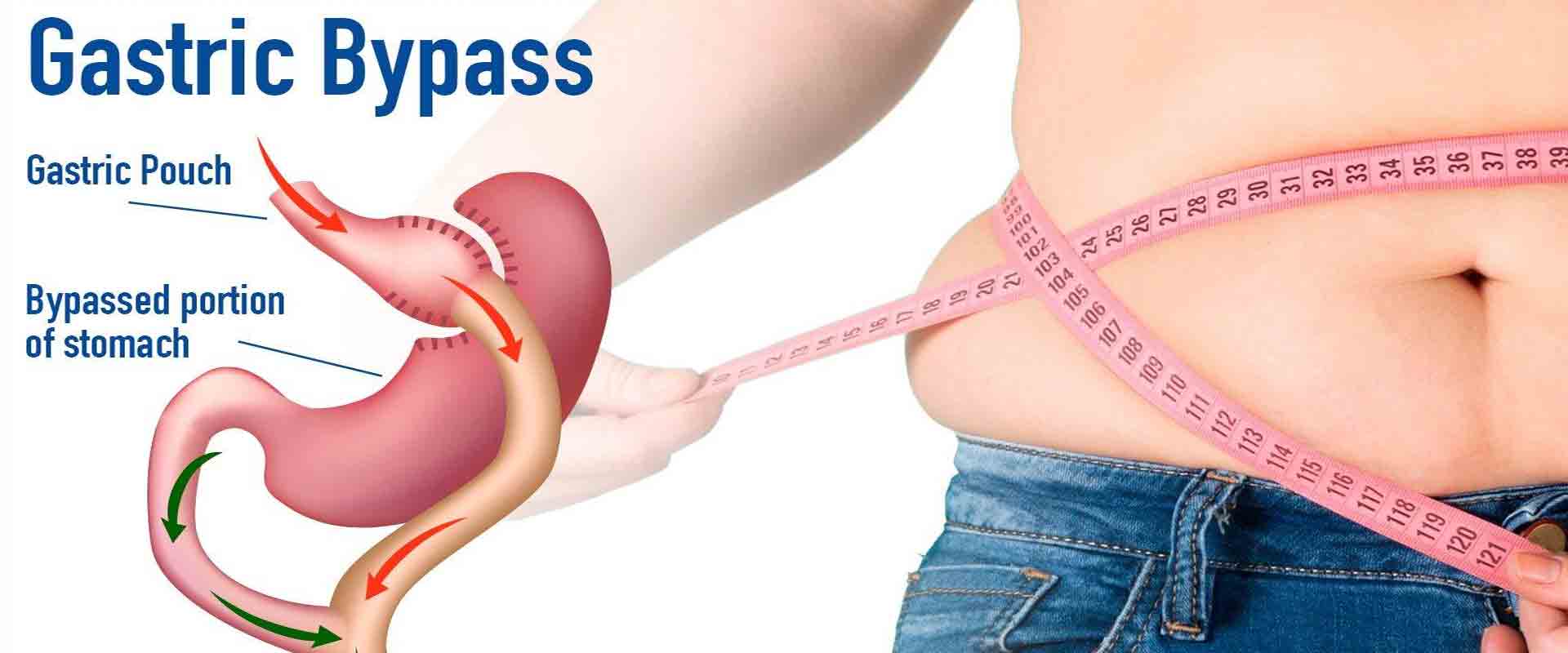 Bypass gastrico
