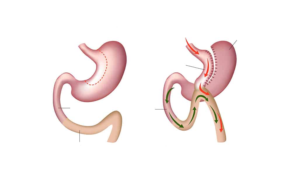 Gastric Bypass Surgery