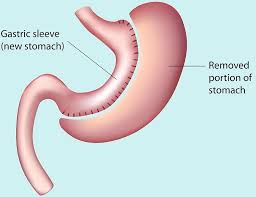 Gastric Sleeve
